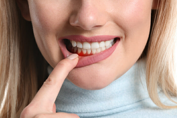 Woman showing red gums with inflammation